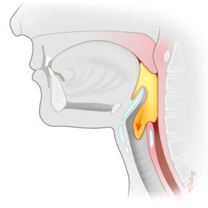 Swallow Smart - Nutrition & Care - Dysphagia